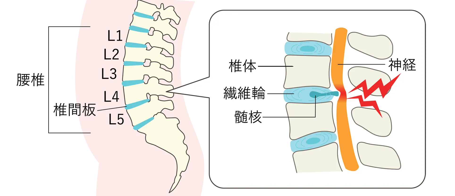 腰椎椎間板ヘルニア